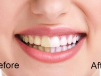 Mẹo lấy cao răng cực đơn giản tại nhà mà chẳng tốn một xu